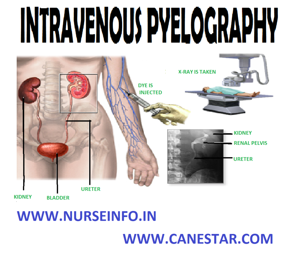 INTRAVENOUS PYELOGRAPHY – Purpose, Contraindications, Preparation of the Patient, Position of the Patient, Procedure, After Care, Recording and Reporting and Complications (NURSING PROCEDURE)