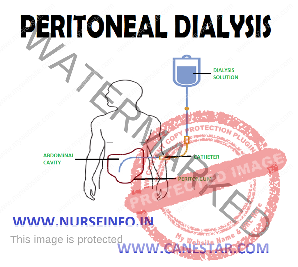 PERITONEAL DIALYSIS – Definition, Purpose, Indications, Advantage, Principles, Types, Advantages, Preparation of the Patient and Environment, Equipment, For Dressing Changes, Procedure and Complications (NURSING PROCEDURE) 