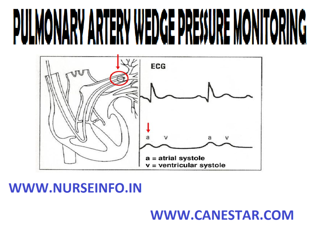 PULMONARY ARTERY WEDGE - PRESSURE MONITORING – Definition, Purpose, Principle, Client and Equipment Preparation, Equipment, Procedure, Checking a PAWP Reading, Removing the Catheter, Special Consideration and Complications  (NURSING PROCEDURE) 