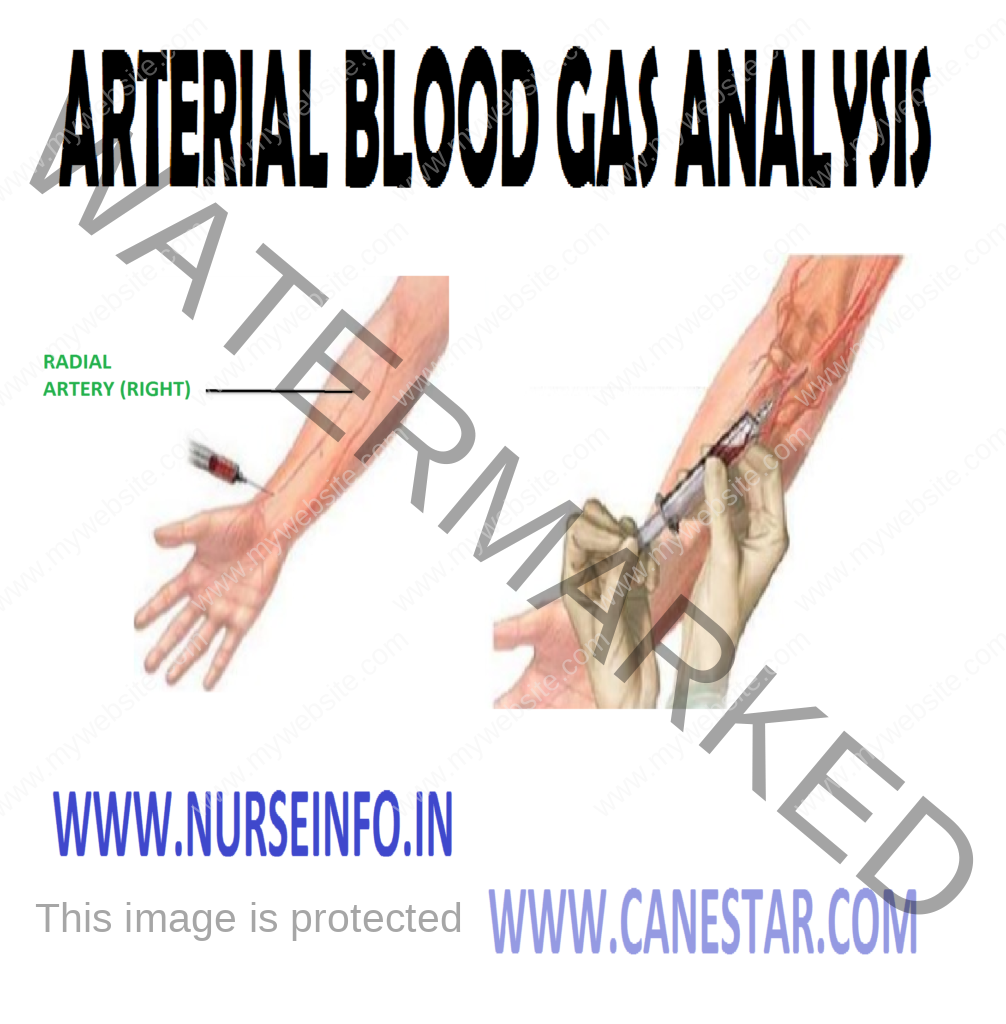 ARTERIAL BLOOD GAS ANALYSIS – Definition, Components of ABG, Purpose, Indication, Interfering Factors, General Instructions, Client and Environment Preparation, Equipment Needed, Obtaining Sample by Direct Puncture, Procedure, Post-Procedural Care, Interpretation of ABG and Clinical Symptoms 