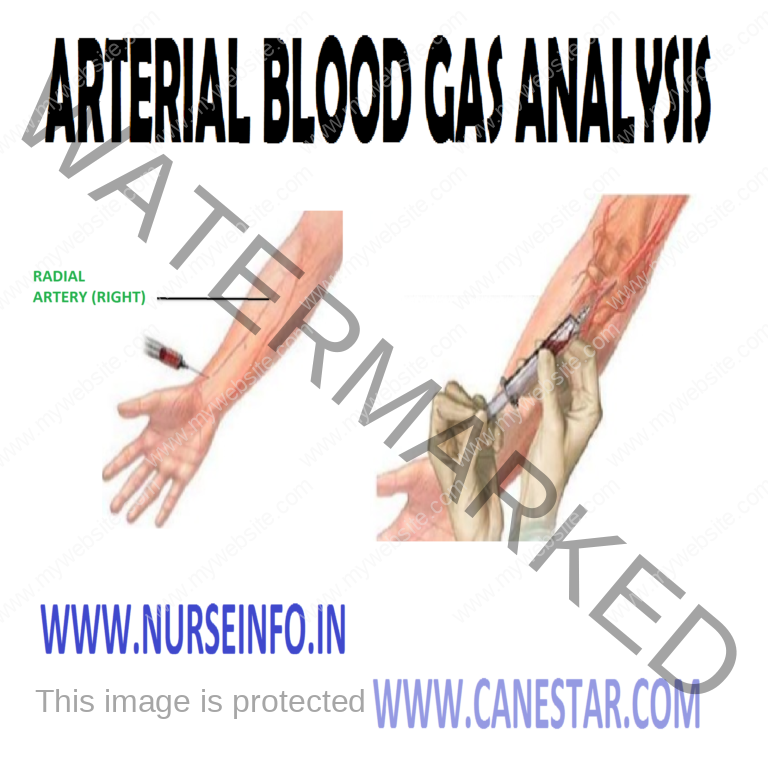 ARTERIAL BLOOD GAS ANALYSIS Nurse Info