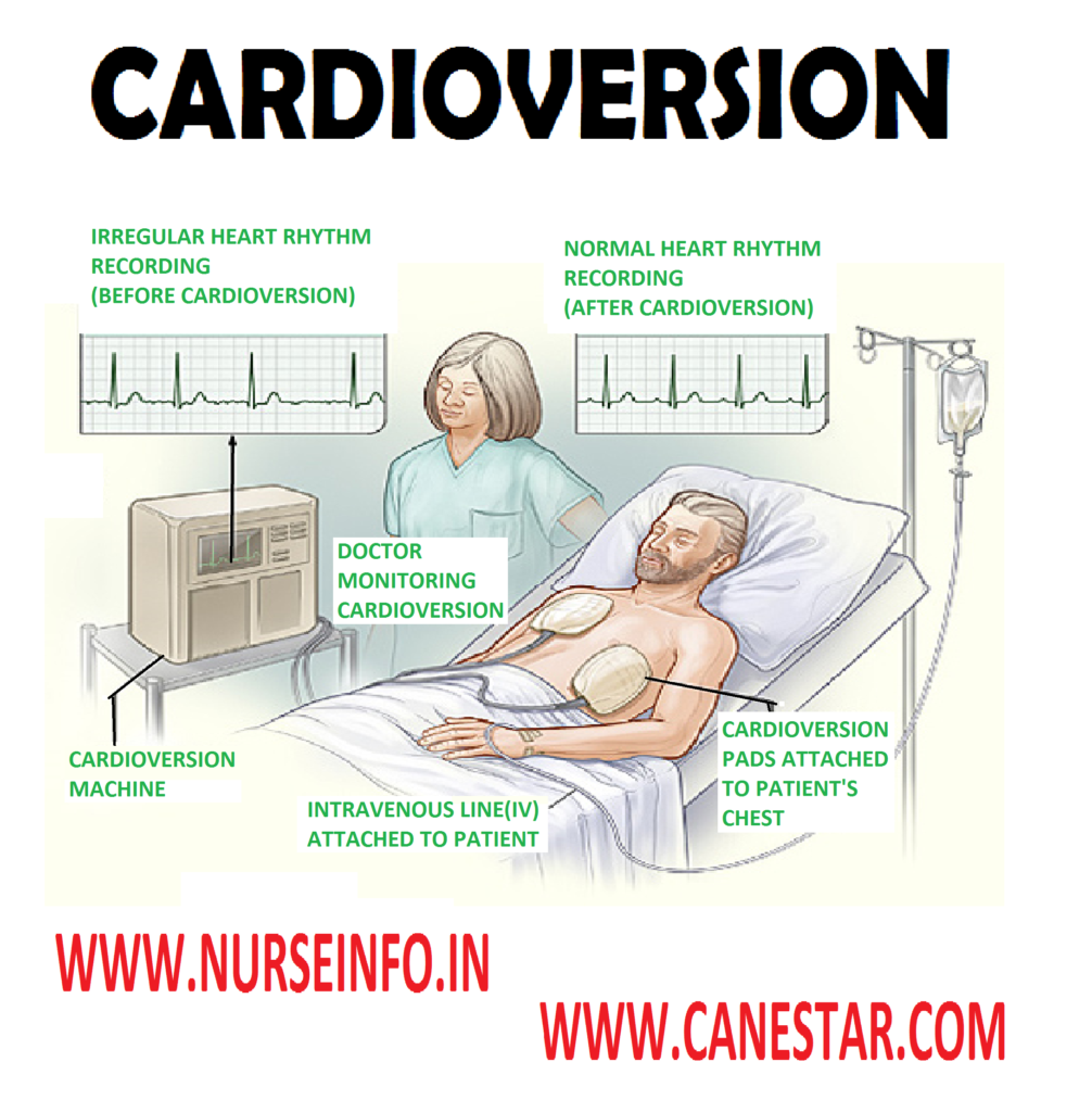 CARDIOVERSION -  Definition and Types