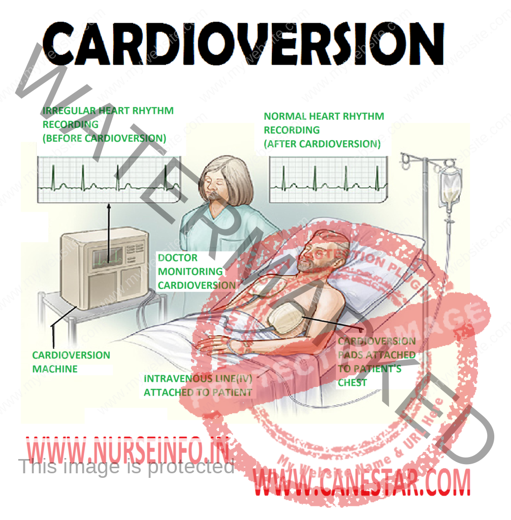 CARDIOVERSION -  Definition and Types