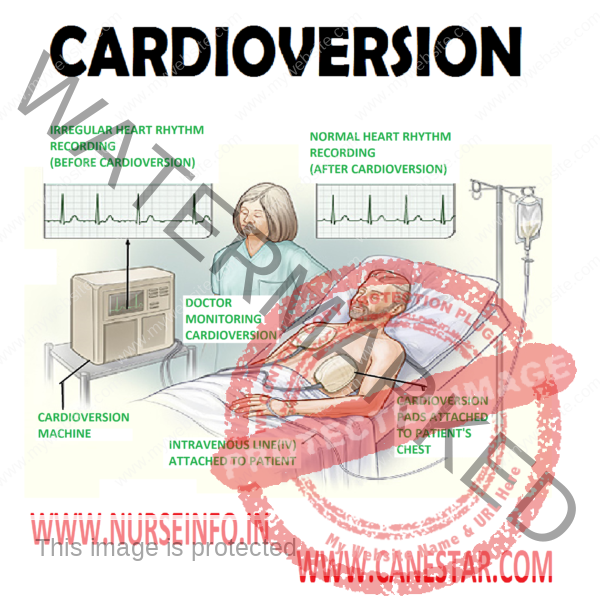 cardioversion-nurse-info