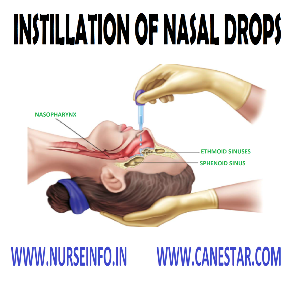 INSTILLATION OF NASAL DROPS - Purpose, Procedure, After Care, Equipment