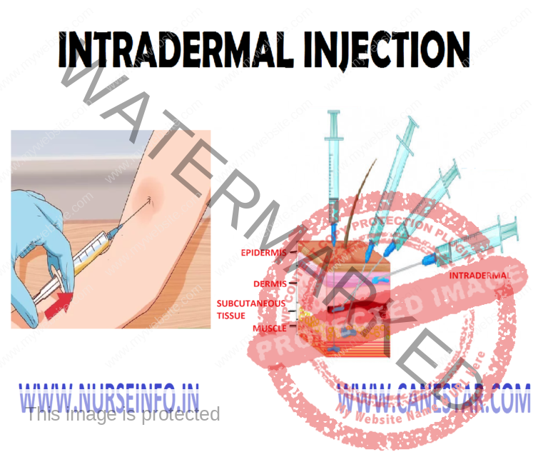 INTRADERMAL INJECTION - Nurse Info