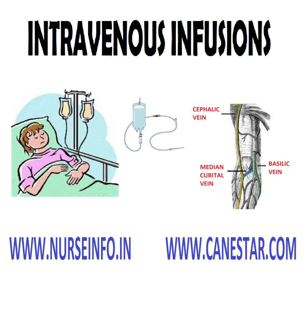 INTRAVENOUS INFUSIONS - Purpose,  Instructions,  Equipment, After Care, Procedure, Complications, After Care, Patient Education, Assessment