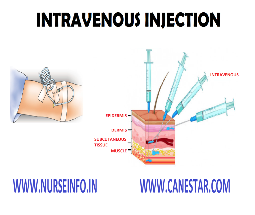  INTRAVENOUS INJECTIONS - Purpose, Sites, Instructions, Administration, Equipment, After Care, Procedure, Complications 
