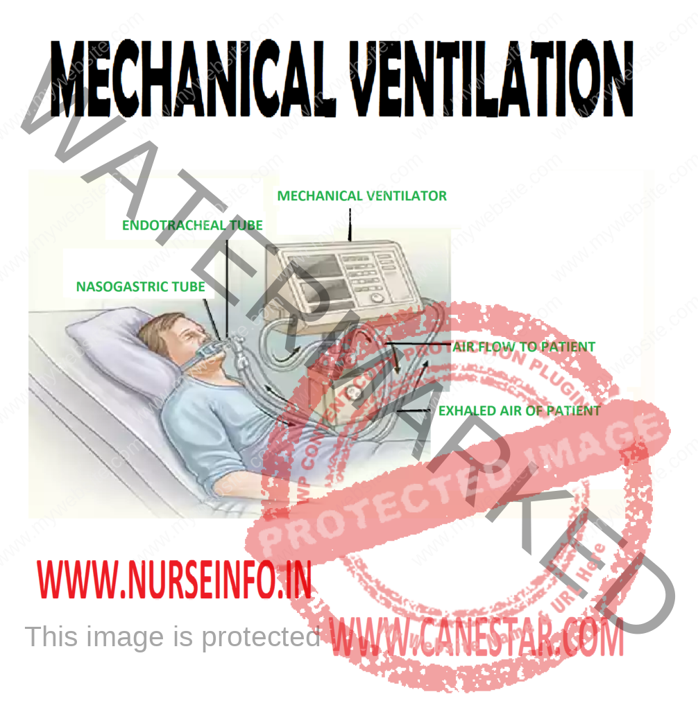 MECHANICAL VENTILATION – Definition, Purpose, Indications for Ventilatory Support, Equipment, Positive Pressure Ventilation, Types of Positive Pressure Ventilators, Pressure Cycled, Modes of Mechanical Ventilation, Uses of IMV, Synchronized Intermittent Mandatory Ventilation (SIMV), Special Positive Pressure Ventilation Technique, Newer Modes of Mechanical Ventilation, Pressure Support Ventilation, High Frequency Ventilation and Procedure