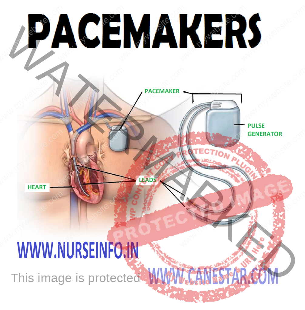 PACEMAKERS - Components of Pacemakers, Indications for Artificial Pacemakers and Temporary Introduction Sites 