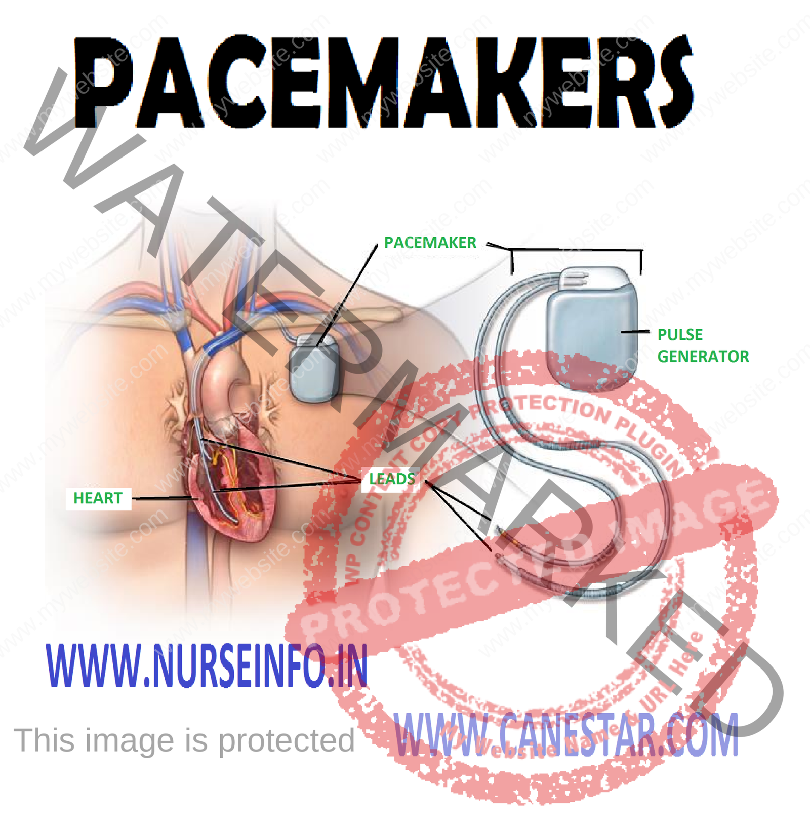 PACEMAKERS - Nursing Notes, MCQs & Procedures %post_title% | NurseInfo ...