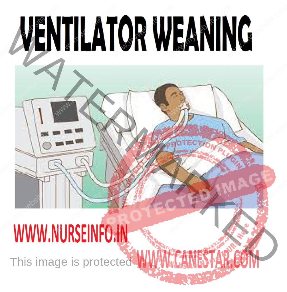 VENTILATOR WEANING – Respiratory Parameters (Huba), Signs of Fatigue, Methods of Fatigue, Methods of Weaning, Causes of Failure to Wean and Patient Who is Fighting the Ventilator 