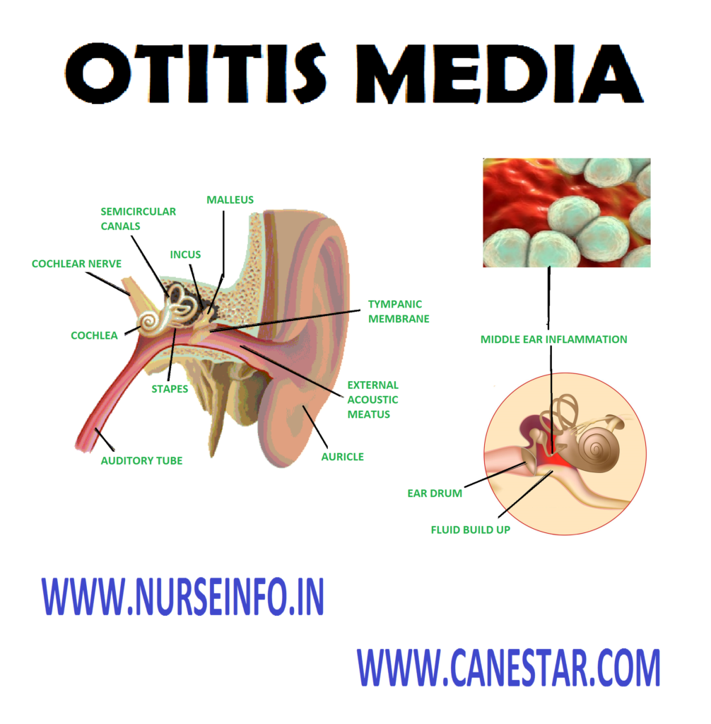 OTITIS MEDIA – Types, Etiology, Signs and Symptoms, Diagnostic Evaluation, Complications, Management and Nursing Management