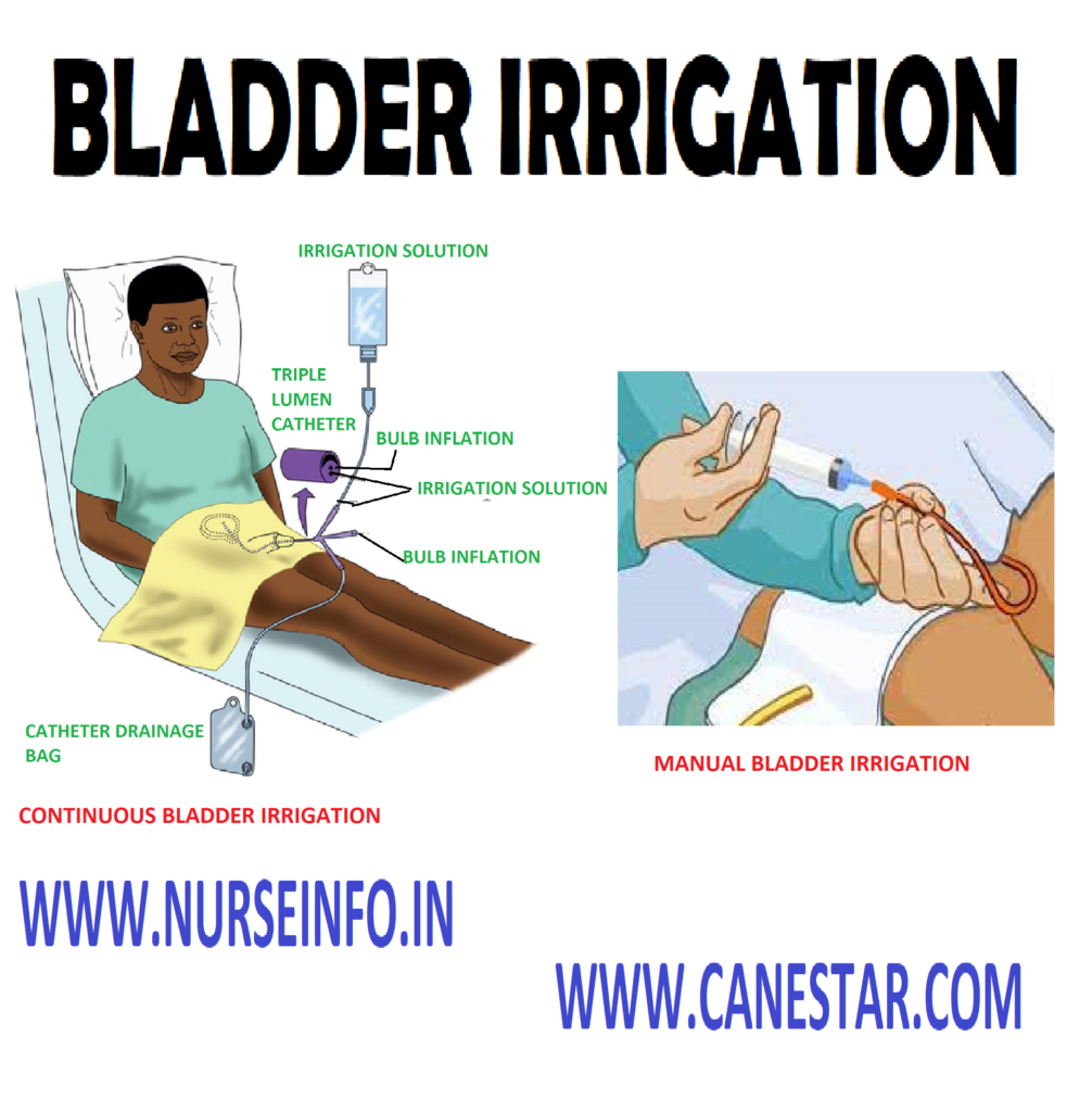 BLADDER IRRIGATION - Purpose, Solution, Instructions, Administration methods, Preliminary Assessments, Preparation of patient and environment, Equipment, Procedure, After care