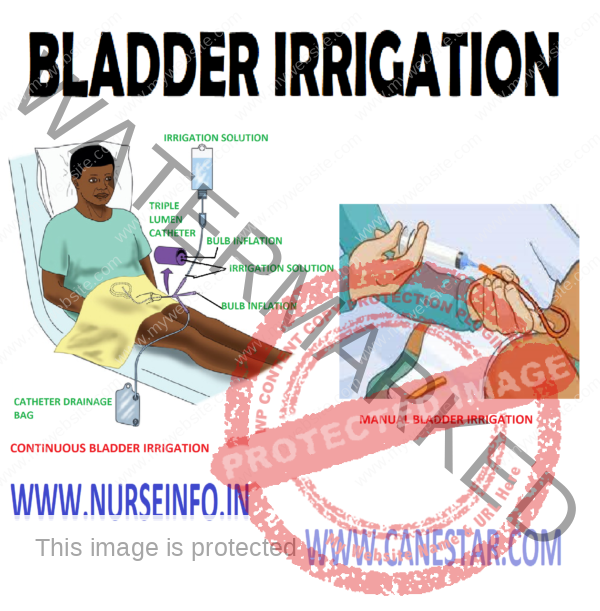 Bladder irrigations procedure and purpose OVER