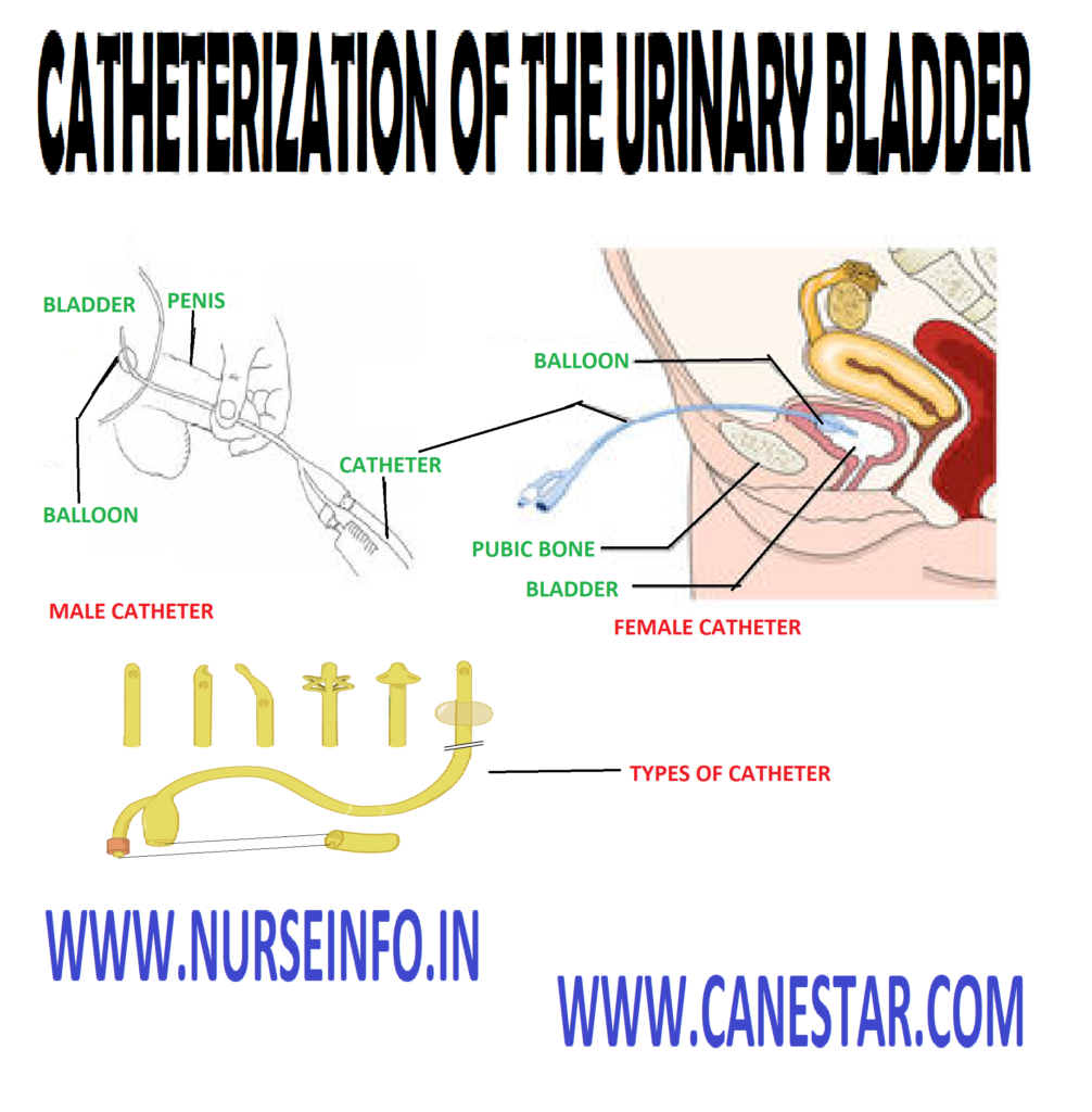 CATHETERIZATION OF THE URINARY BLADDER - Purpose, Principle, Instruction, Preliminary Assessment, Preparation of Patient and Environment,  Types of Urinary Catheters, Equipment, Procedure, After care, Types of Catheterization
