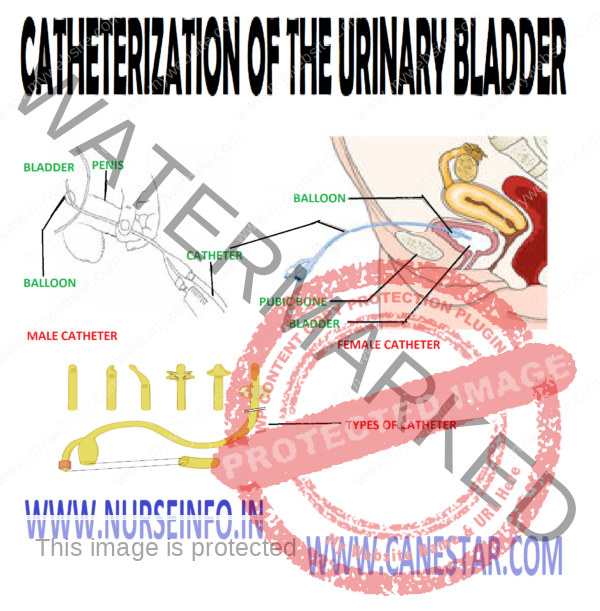 Urinary Catheterization - Reasons, Purpose And Procedure