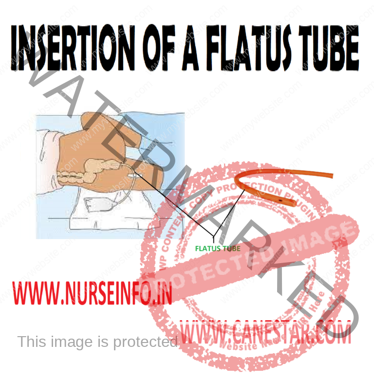 Insertion Of A Flatus Or Rectal Tube Purpose Instructions