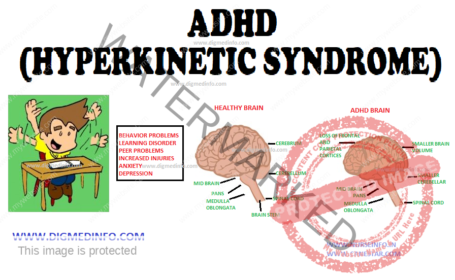 ATTENTION DEFICIT HYPERACTIVITY DISORDER – ADHD (HYPERKINETIC SYNDROME) 