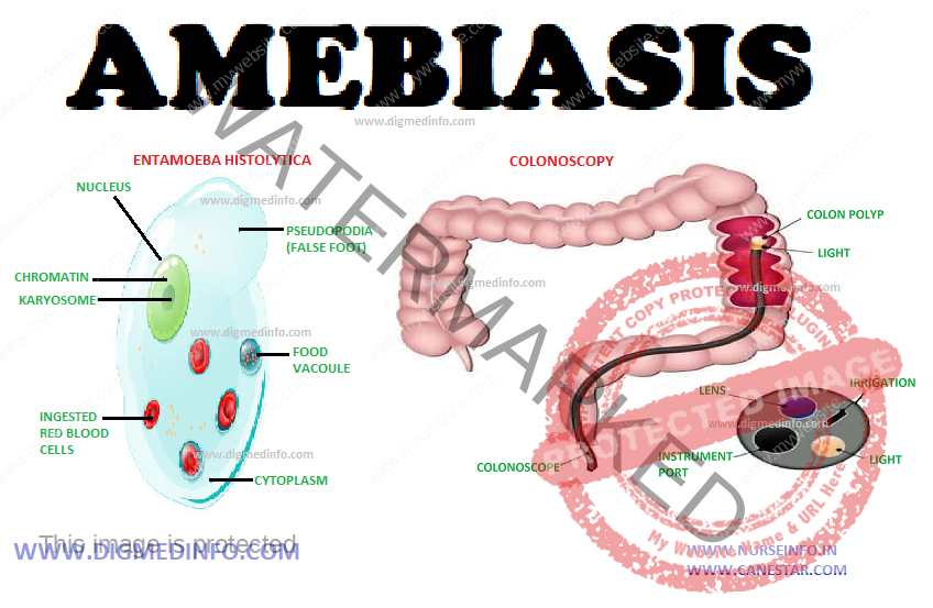 AMEBIASIS – General Characteristics, Pathology, Clinical Manifestations, Acute Amebic Dysentery, Hepatic Amebiasis and Treatment of Amebiasis