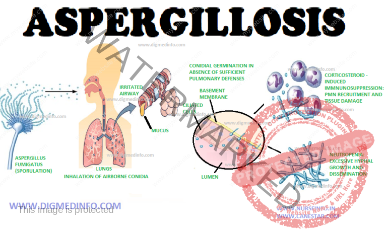 Aspergillosis General Characteristics Pathogenesis And Treatment 