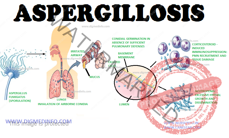 ASPERGILLOSIS – General Characteristics, Pathogenesis and Treatment 