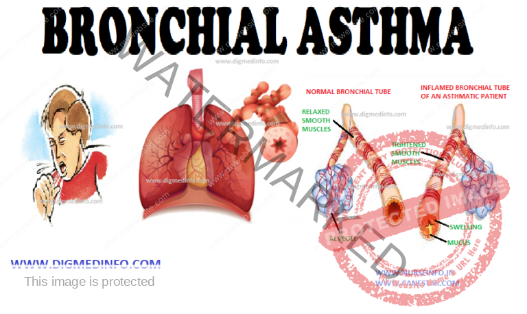 research on bronchial asthma