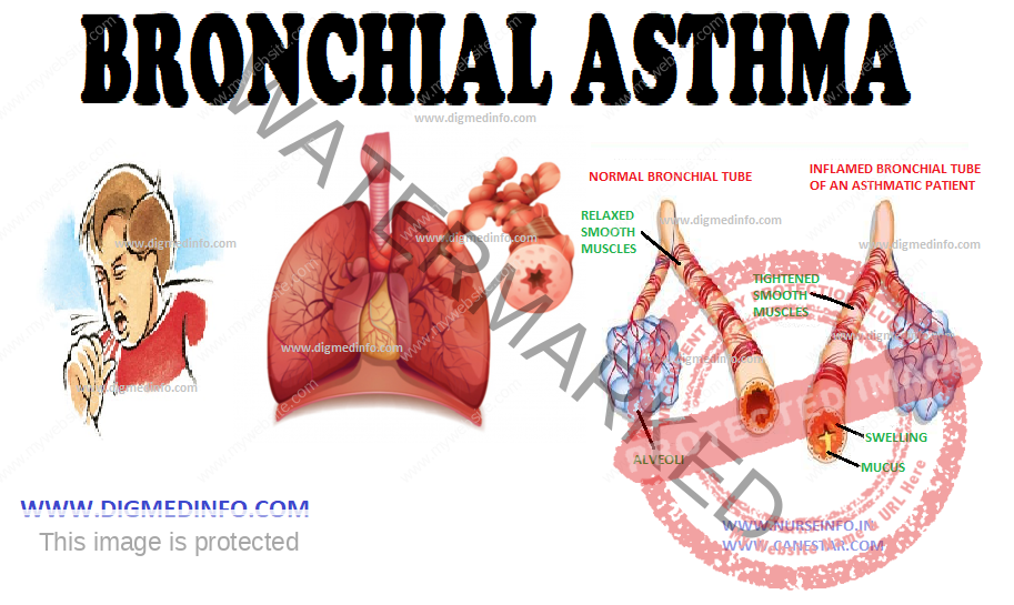 BRONCHIAL ASTHMA – General Characteristics, Pathology, Clinical Features, Diagnosis, Treatment and Prevention 