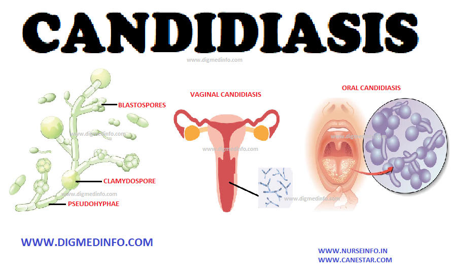CANDIDIASIS – General Characteristics, Diagnosis and Treatment 