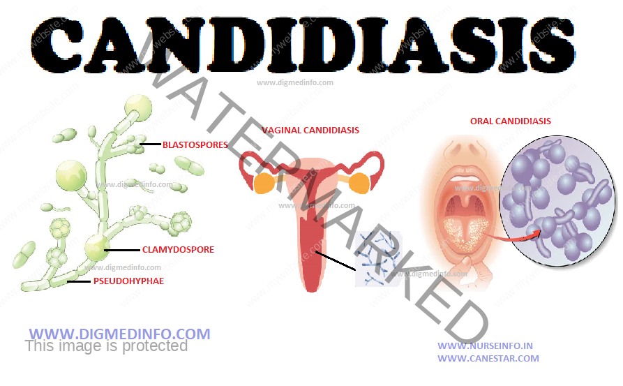 CANDIDIASIS – General Characteristics, Diagnosis and Treatment 