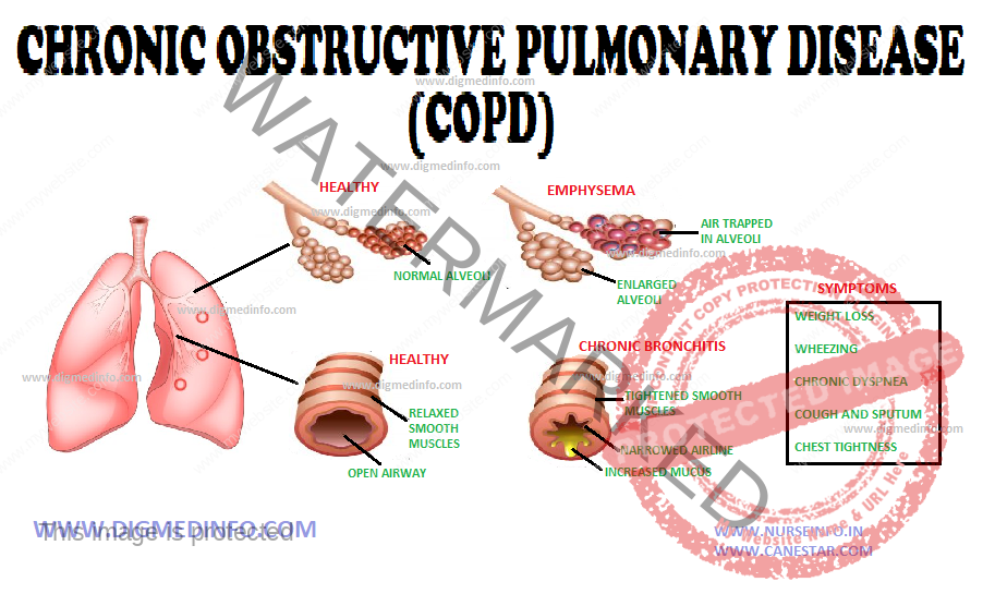 COPD (Chronic Obstructive Pulmonary Disease) CHRONIC BRONCHITIS – General Characteristics, Pathogenesis, Pathology, Clinical Features, Diagnosis and Management 