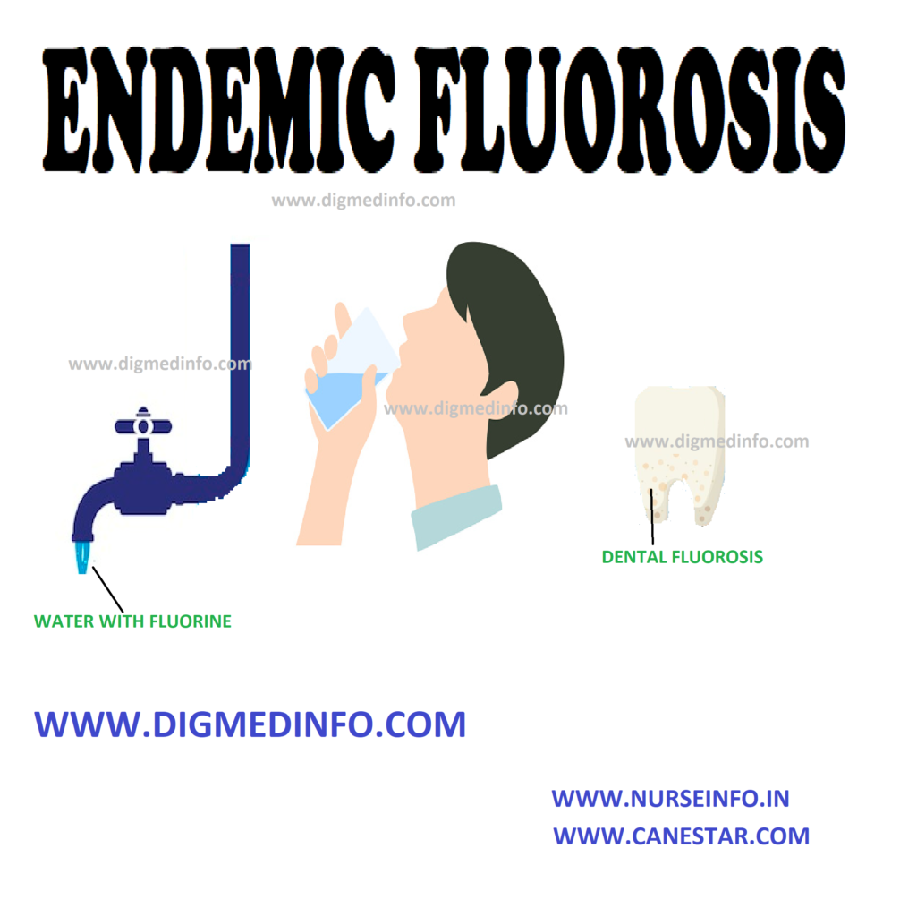 ENDEMIC FLUOROSIS – Epidemiology, Pathophysiology, Clinical Features, Skeletal Fluorosis, Complications, Investigations, Treatment and Prevention 