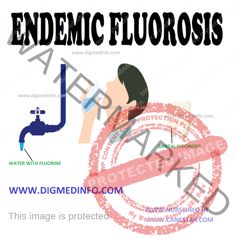 ENDEMIC FLUOROSIS – Epidemiology, Pathophysiology, Clinical Features, Skeletal Fluorosis, Complications, Investigations, Treatment and Prevention 