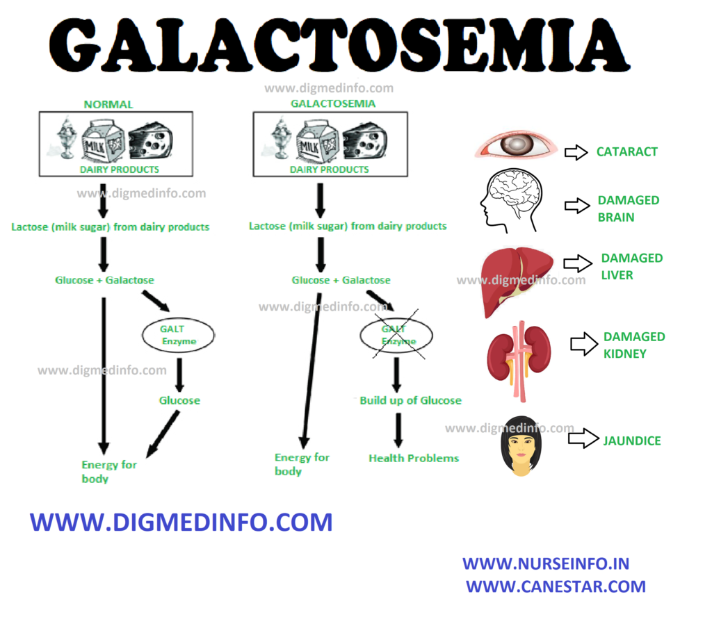 GALACTOSEMIA – Definition, Diagnosis and Treatment