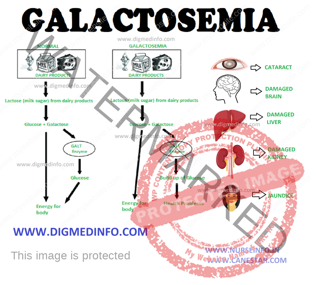 GALACTOSEMIA – Definition, Diagnosis  and Treatment 