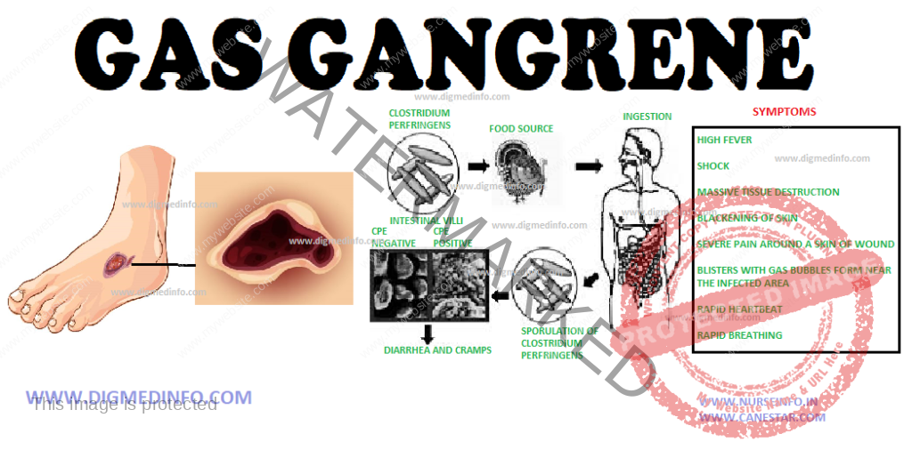 GAS GANGRENE (Clostridial myonecrosis – General Characteristics, Pathogenesis, Clinical Features, Diagnosis and Treatment 