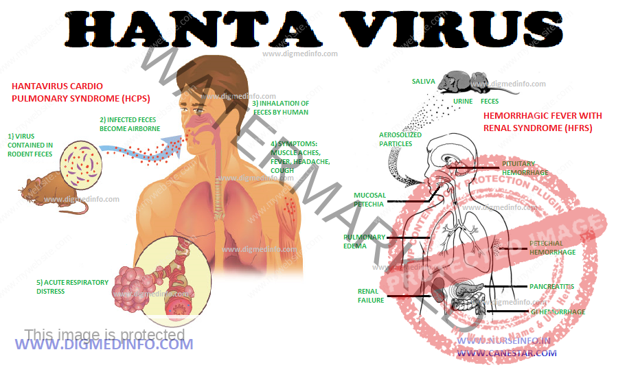 HANTA VIRUS – HFRS and HCPS and Treatment 