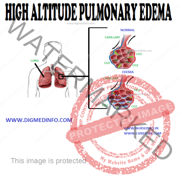 HIGH ALTITUDE PULMONARY EDEMA Pathophysiology Clinical Features 