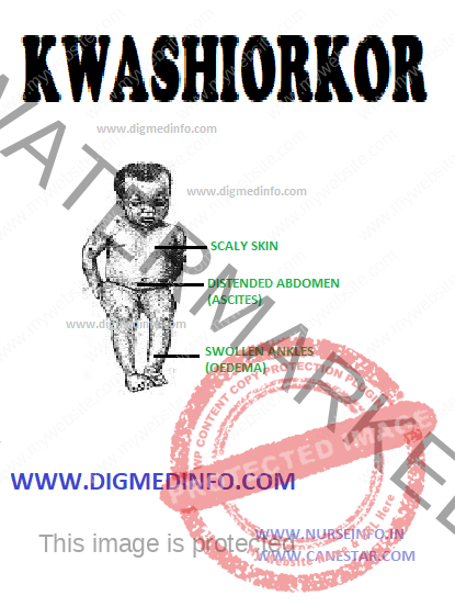 KWASHIORKOR – General Features, Pathology and Clinical Features
