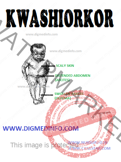 Kwashiorkor General Features Pathology And Clinical Features Nurse