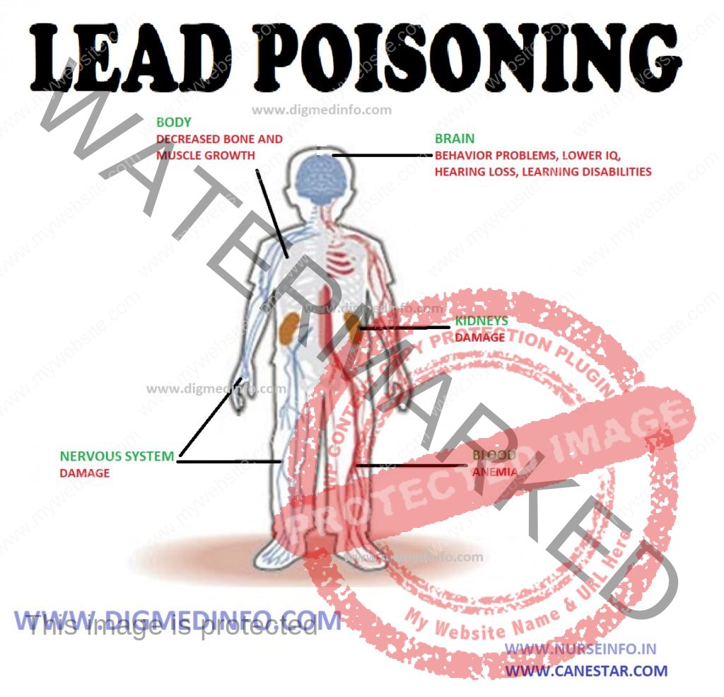 LEAD POISONING – General Features, Treatment, Chronic Lead Poisoning – Diagnosis, Treatment and Prevention 