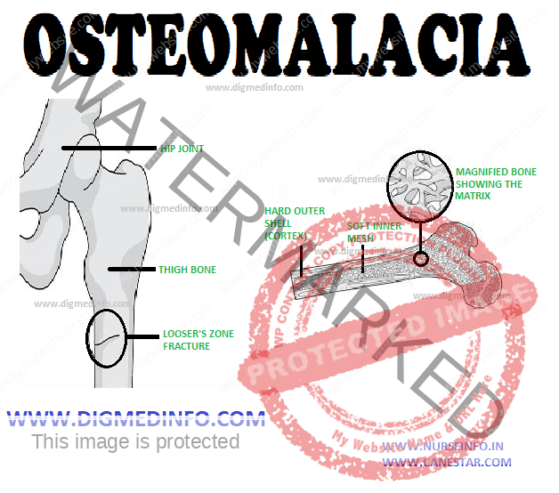 OSTEOMALACIA – Definition, Etiology, Clinical Features and Treatment 