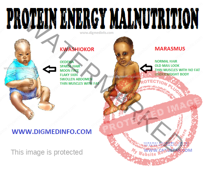 PROTEIN ENERGY MALNUTRITION – General Characteristics, Etiology and Pathogenesis, Clinical Features (Kwashiorkor and Marasmus) 