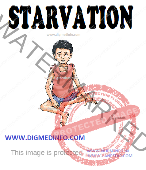 STARVATION  - General Characteristics, Clinical Features and Treatment 