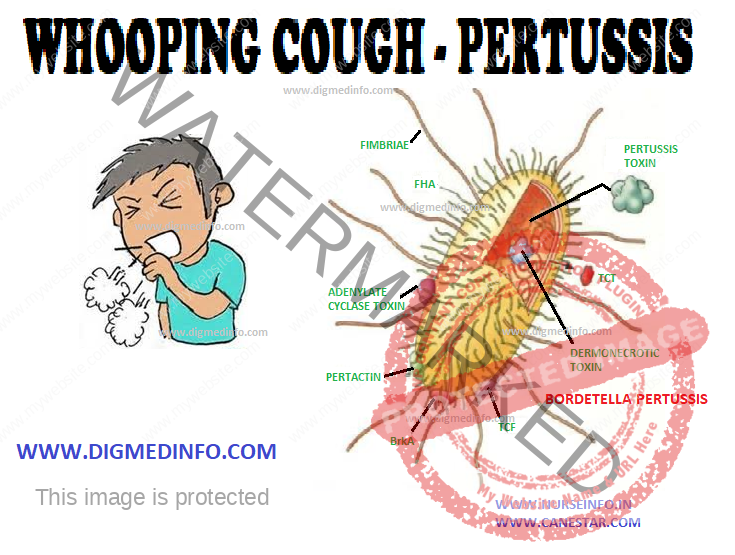 WHOOPING COUGH – PERTUSSIS – Definition, Pathology, Clinical Manifestations, Diagnosis, Treatment and Prevention 