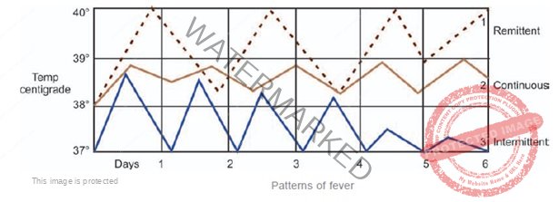 Patterns of Fever